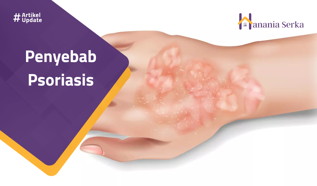 Read more about the article Penyebab Psoriasis