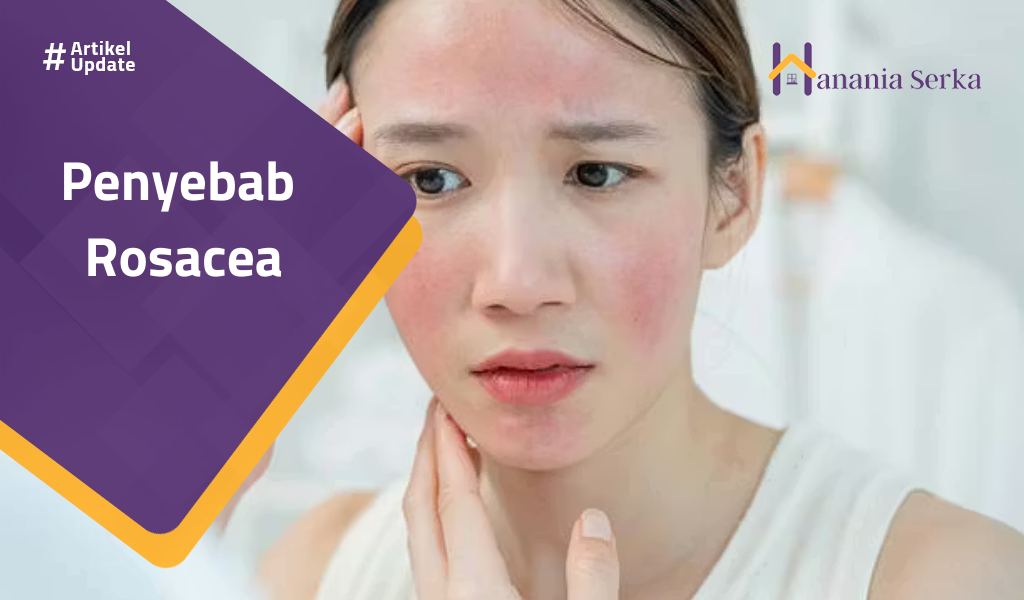 Read more about the article Penyebab Rosacea