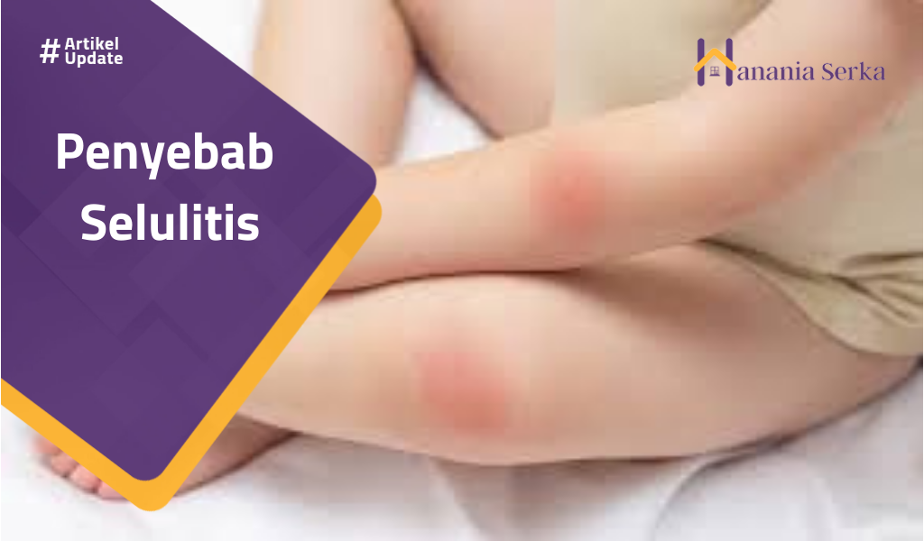 You are currently viewing Penyebab Selulitis