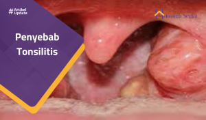 Read more about the article Penyebab Tonsilitis