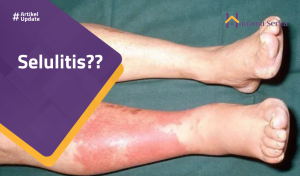 Read more about the article Selulitis??