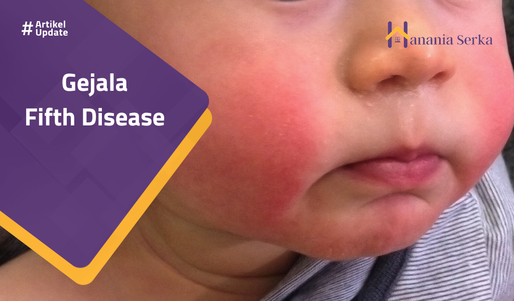 You are currently viewing Gejala Fifth Disease