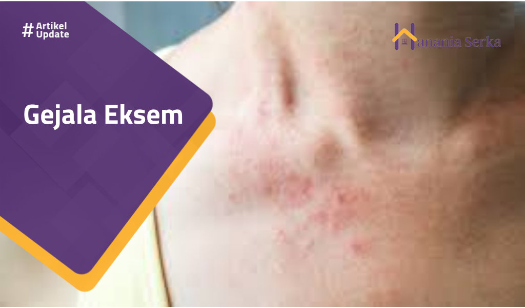 You are currently viewing Gejala Eksem