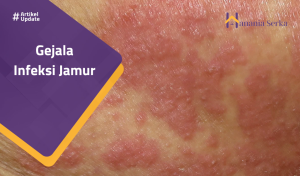 Read more about the article Gejala Infeksi Jamur