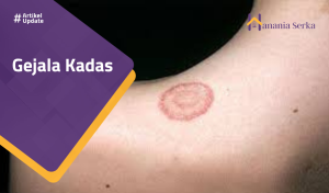 Read more about the article Gejala Kadas