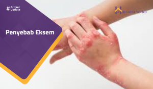 Read more about the article Penyebab Eksem