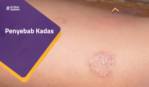 Read more about the article Penyebab Kadas